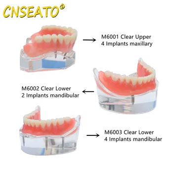 CNSEATO 1 ШТ Зубной Имплантат Демонстрационная Модель зубов Overdenture Модель Реставрации Typodont 2/4 Имплантата Верхний и нижний M6001