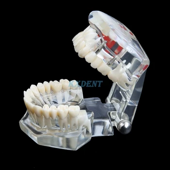 1 шт. Модель зубных имплантатов с реставрационным мостом Для медицинской науки Стоматологии Обучения Изучению заболеваний зубов